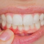 enfermedad periodontal