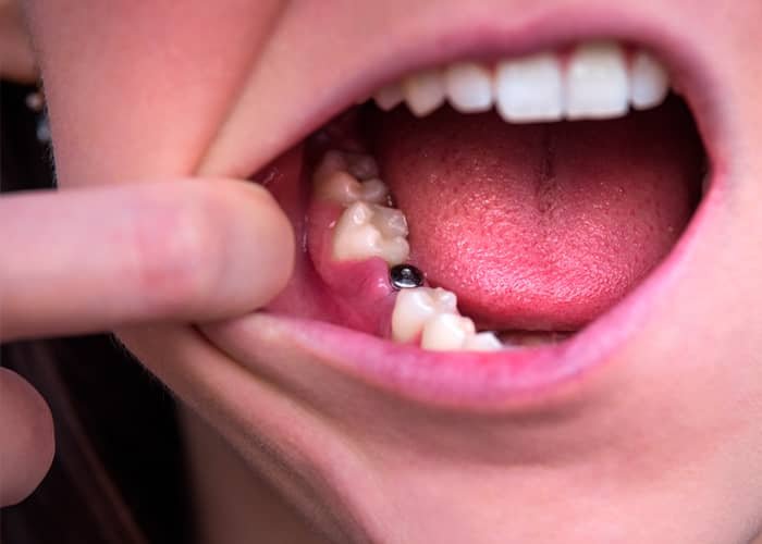 rechazo-implante-dental-clinica-casaus-el-prat