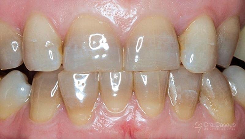 dientes-manchados-tetraciclinas