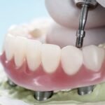 sobredentadura-sobre-implantes-dentales