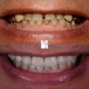 Carillas dentales - Antes y después