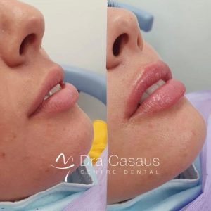 aumento-labios-acido-hialuronico-el-prat-de-llobregat-caso-02
